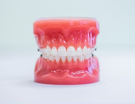 Model of teeth with clear ceramic braces, showcasing orthodontic treatment options at Pechersky Orthodontics, a Pittsburgh orthodontist dedicated to providing expert care for a healthy smile.