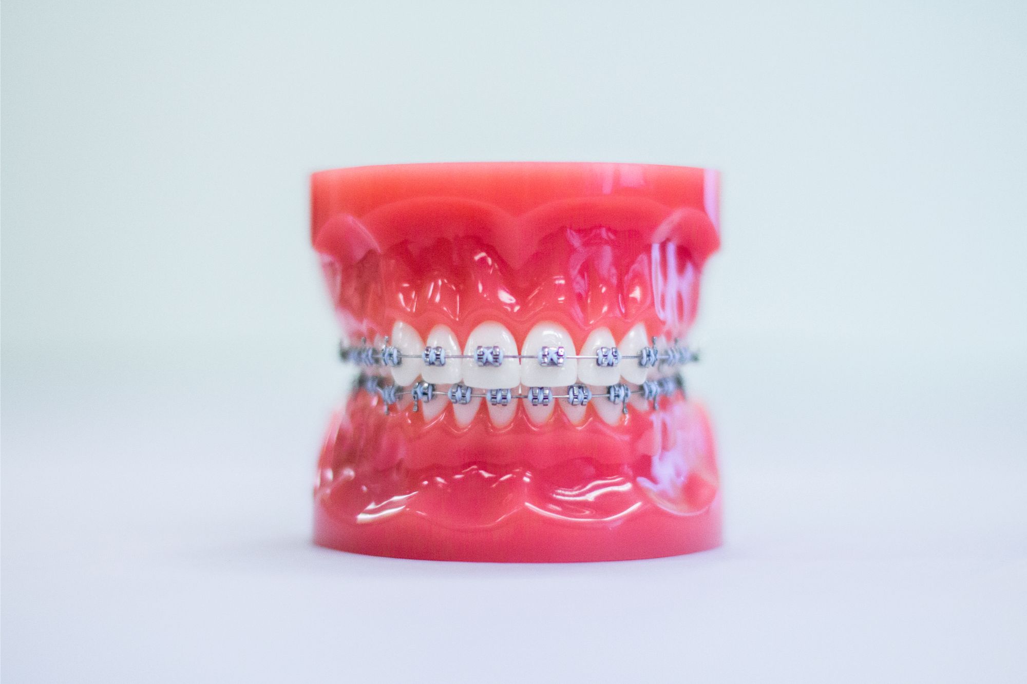 Model of teeth with metal braces, representing orthodontic treatment options at Pechersky Orthodontics in Pittsburgh, PA, highlighting effective solutions for straightening teeth.